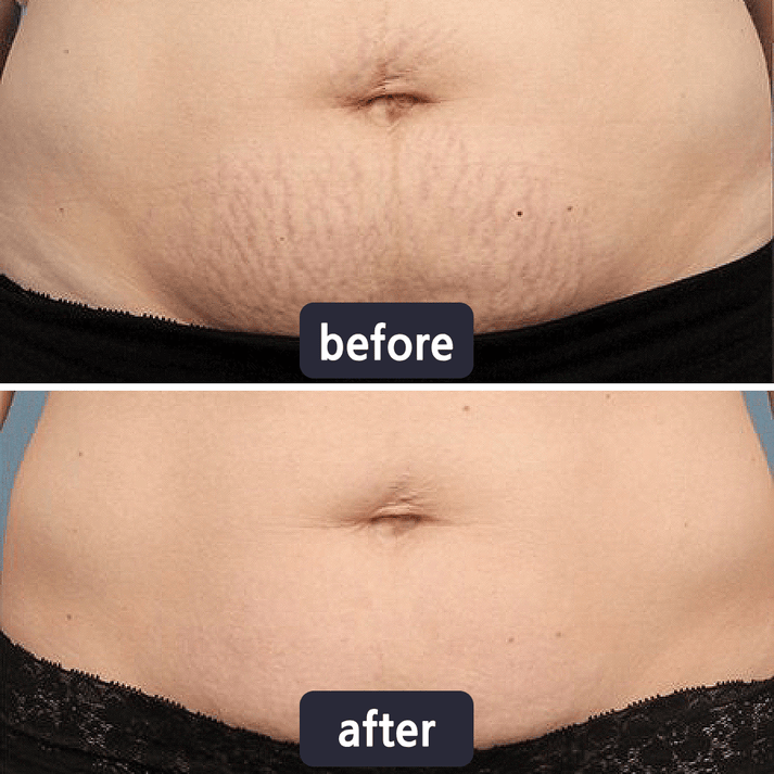 Scar Removal Cream
