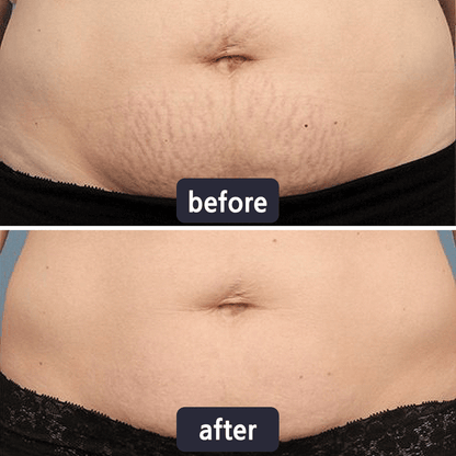 Scar Removal Cream