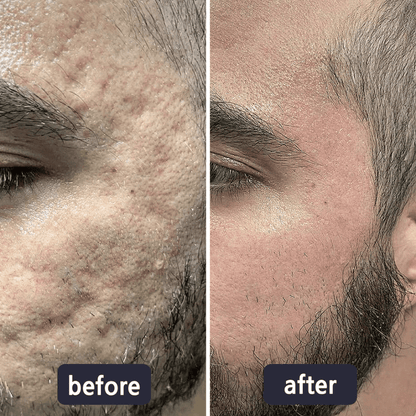 Scar Removal Cream
