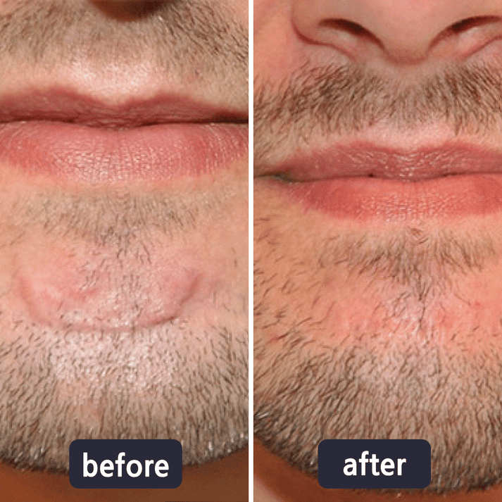 Scar Removal Cream