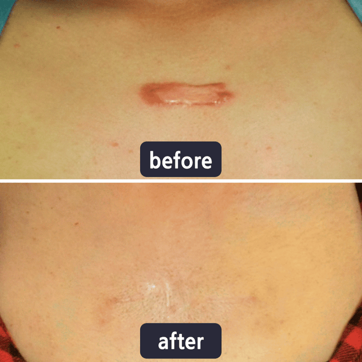 Scar Removal Cream