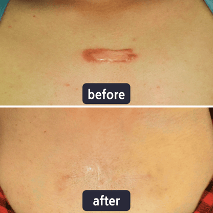 Scar Removal Cream